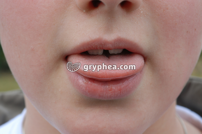 Phénotype langue en gouttière (vue 2) : un caractère  mendélien ? - gryphea.com